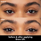 Brow Lift